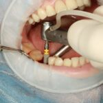 Do I need dental implants